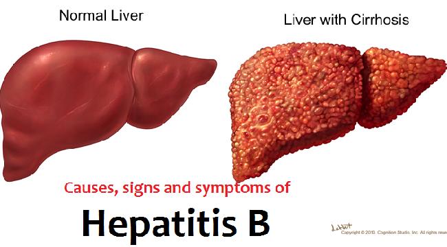 医生,我有乙肝大三阳,吃点什么药?慢性乙肝抗病毒治疗简明指南