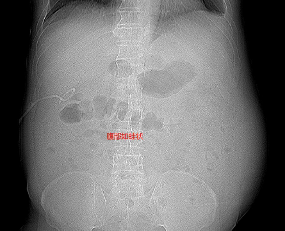 老人肝炎腹胀,25岁小伙腹痛肝癌晚期