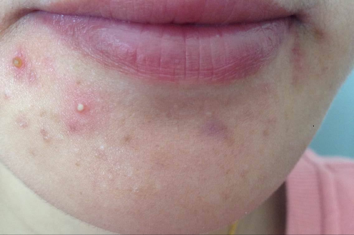 推荐痔疮膏的博主,网红治痔疮的药膏