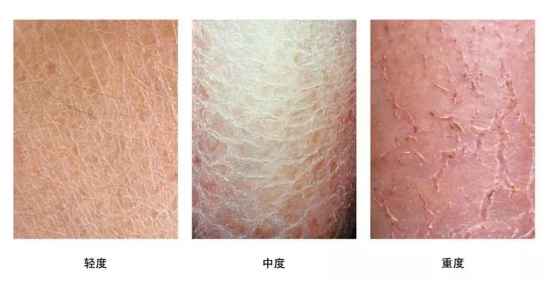 冬季皮肤瘙痒一抓就起疙瘩,老人冬季皮肤瘙痒怎么解决