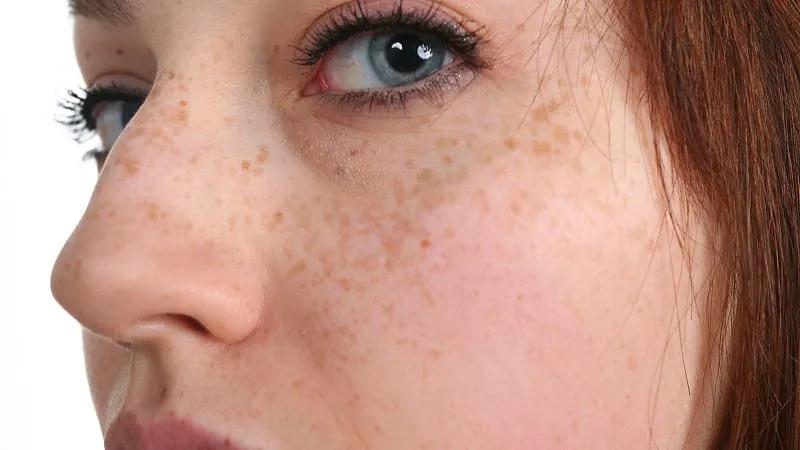 脸上有斑脏腑有瘀中医教你巧化斑,脸上有斑别烦恼老中医推荐2种