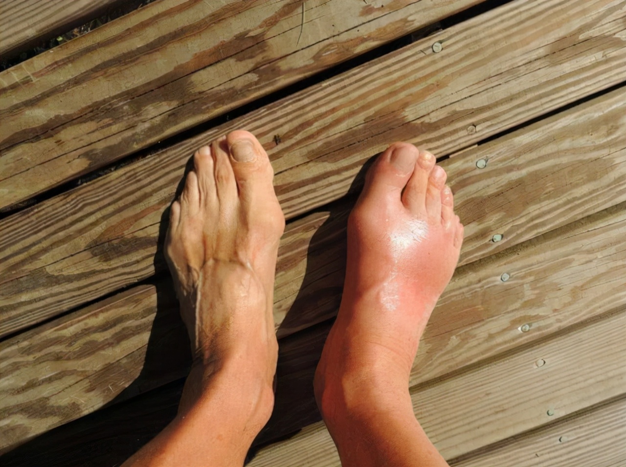 高尿酸五种不能吃,高尿酸是吃出来的少吃六种食物