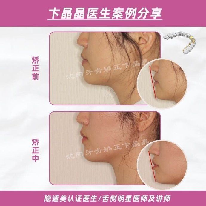 隐适美牙套矫正过程,隐适美个别牙反颌矫正真实案例