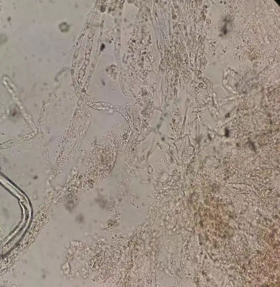 治灰指甲要验血吗,医院检查灰指甲挂号什么科