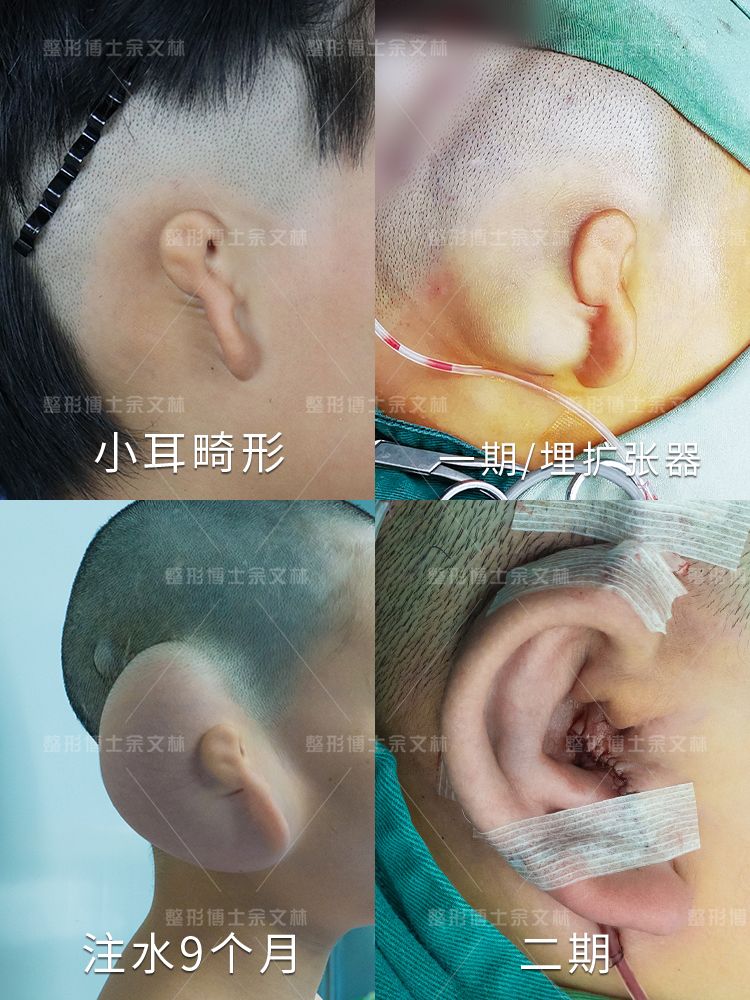 余文林博士耳朵畸形,余文林做耳再造怎么样