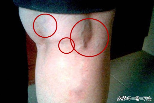 腰痛为什么要选委中穴,为什么腰痛按委中穴很明显呢