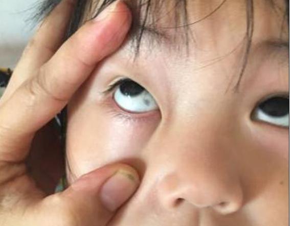 孩子眼睛眼白处有灰黑点,孩子眼睛眼白有黑斑咋回事