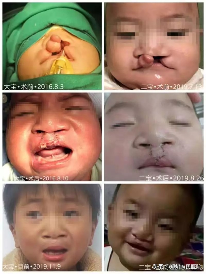 兔唇修复成功视频,完美修复系列