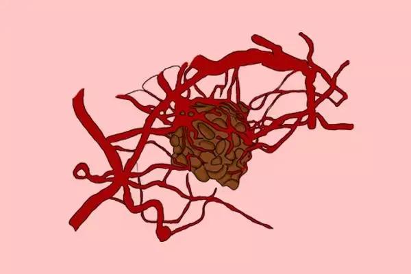 甲状腺结节07x06实性结节严重吗,甲状腺结节1.2厘米囊实性结节