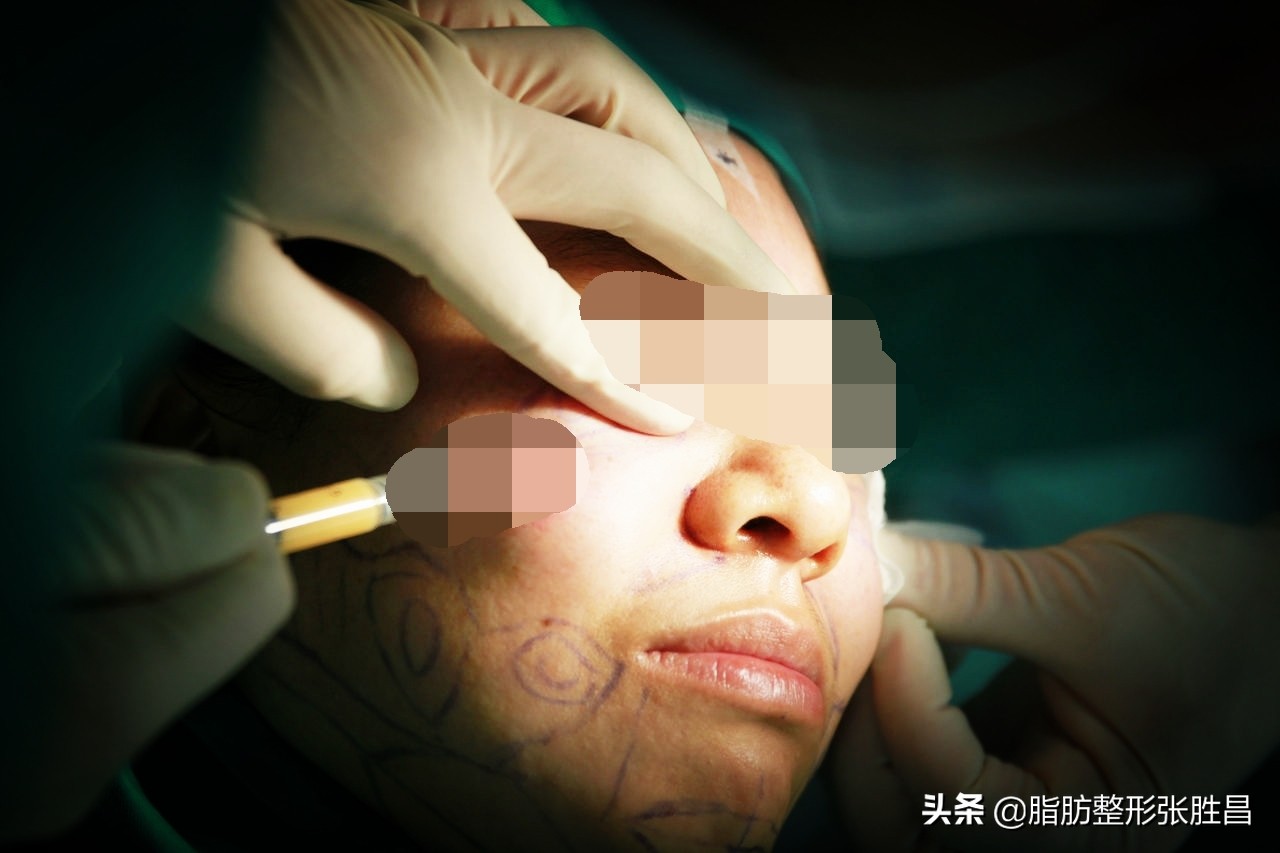 为何面部吸脂会失败？这种整容失败还有得救吗？今日医生揭开谜底