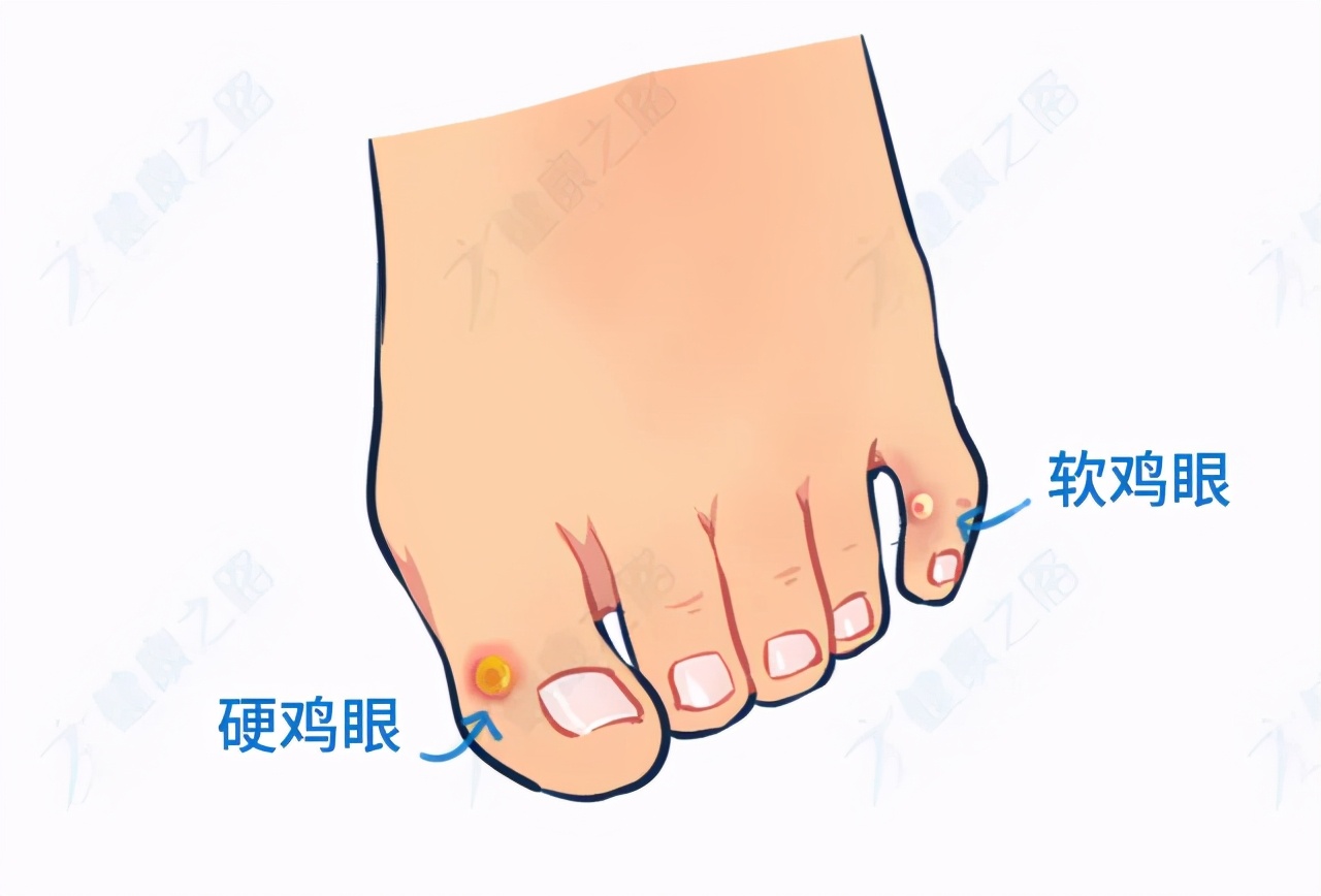 脚底长了鸡眼该怎么正确处理,脚底长鸡眼太深怎么挖出来