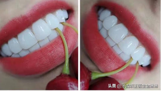 牙医说装烤瓷牙冠,牙医做牙冠疼吗