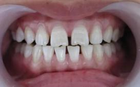 牙缝大一吃东西就塞得痛怎么办,牙缝越剔越大是真的吗