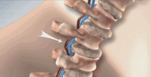 得了颈椎病最好的锻炼方法,颈椎病的自我治疗方法颈椎操