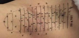 腋臭特效药一览表,miradry微波腋臭手术哪里可以做