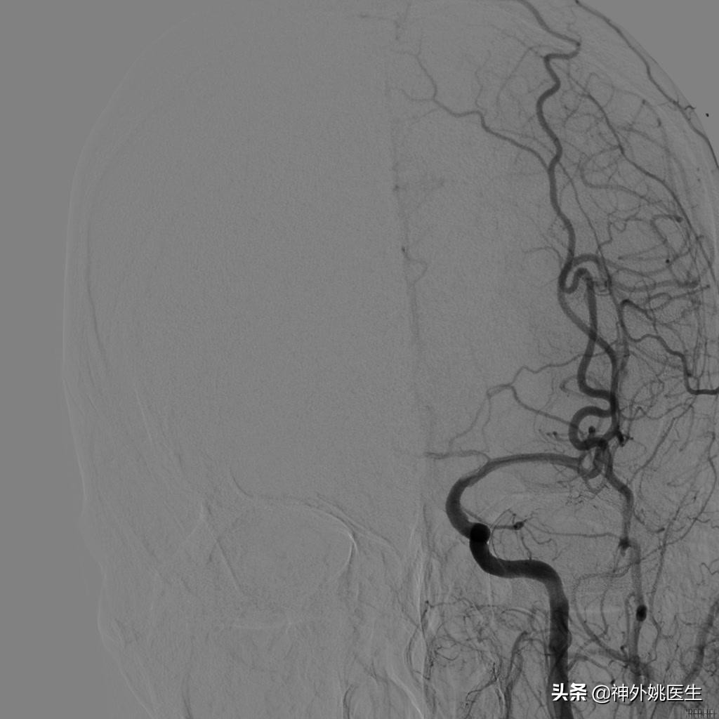 颈内动脉狭窄内膜剥脱术风险大吗,颈动脉内膜摘除手术