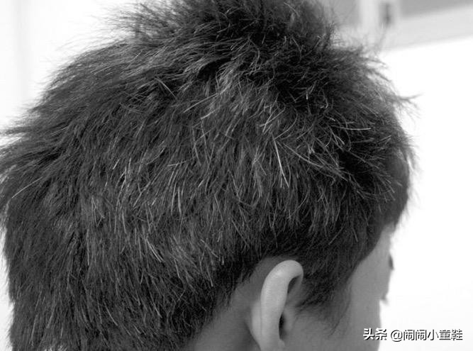 男士头发出油有头屑用什么洗发水,头发干枯毛躁痒有头屑掉发怎么办