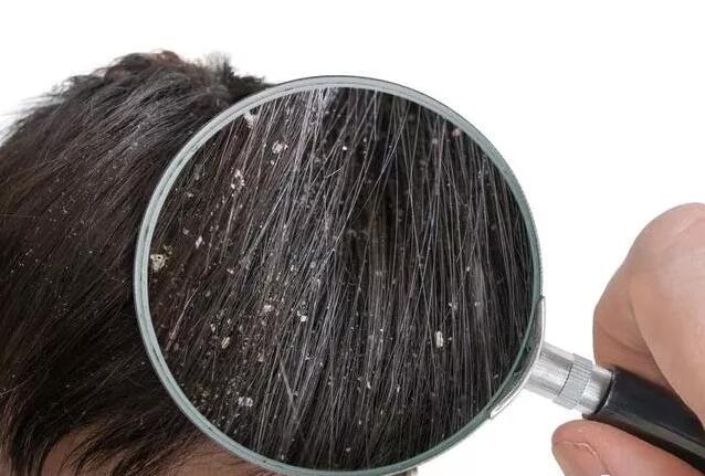 天天洗头头皮屑多像雪花解决办法,天天洗头还有头皮屑头皮发痒脱发