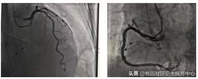 早期心梗心电图能查出来吗,警惕这种要命的心电图表现