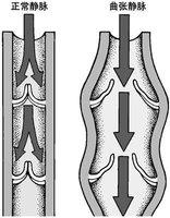 “医生，我腿上一条条青筋是怎么回事，像蜘蛛网、像蚯蚓”