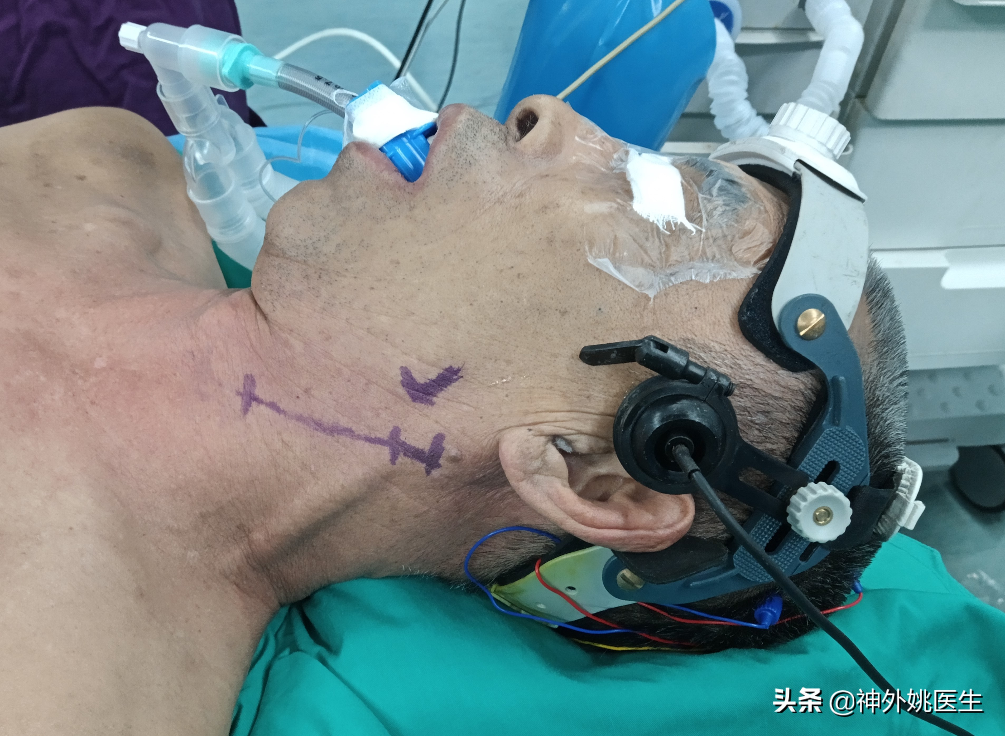 颈内动脉狭窄内膜剥脱术风险大吗,颈动脉内膜摘除手术