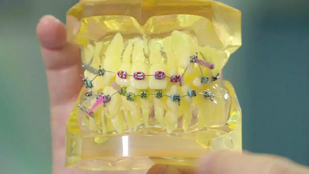 后槽牙的牙齿有点歪可以矫正吗,矫正牙齿过程中牙齿歪了正常吗