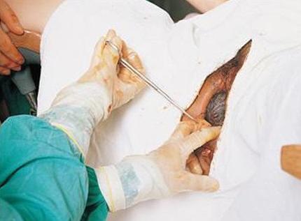 每个孕妇顺产大部分都是侧切吗,为什么孕妇都选择顺产