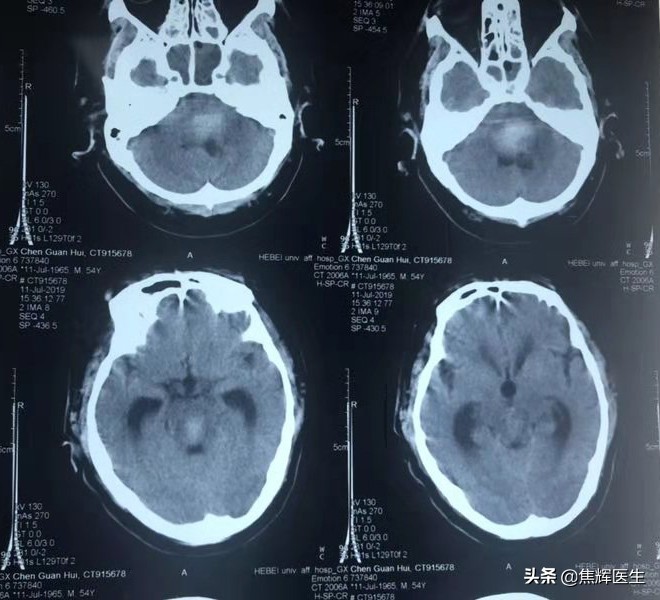 脑干出血最好的自己锻炼方法,怎么快速让脑干出血康复治愈