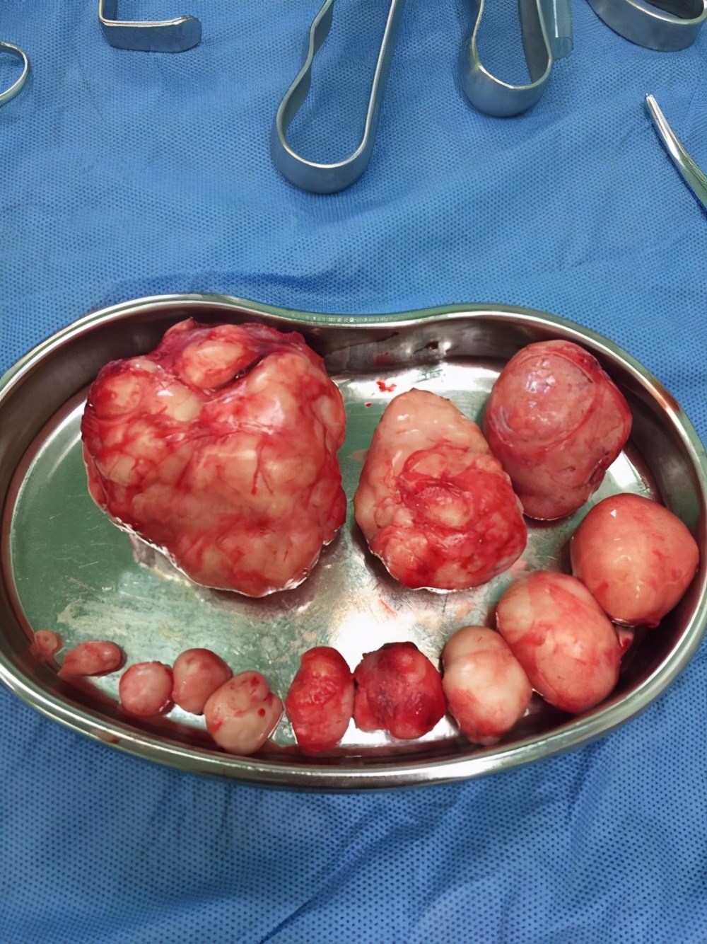 女子查出子宫肌瘤,女性45岁诊断为子宫肌瘤