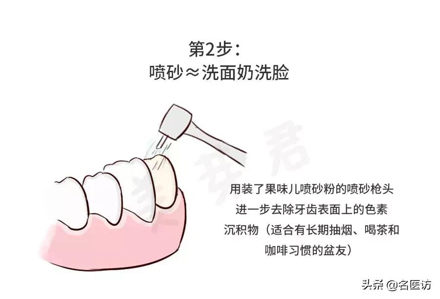 洗牙攻略,洗牙全攻略