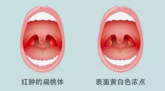 上火引起的扁桃体发炎多久能好,上火引起的扁桃体发炎怎么办