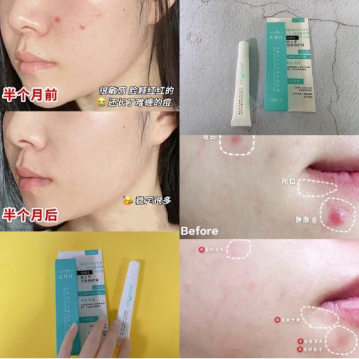 美摩仕祛痘膏效果好吗,美摩仕祛痘效果好吗