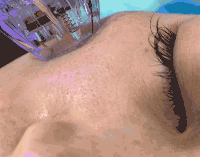 皮肤油毛孔粗大,油痘肌黑头毛孔粗大