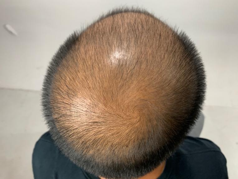 怎样才能不脱发掉发,脱发头发越来越细