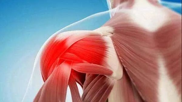 让你不再“肩”熬——肩峰下撞击综合征全攻略