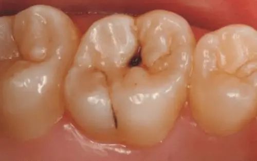 去口臭清洁口腔牙渍,口臭牙臭去除神器