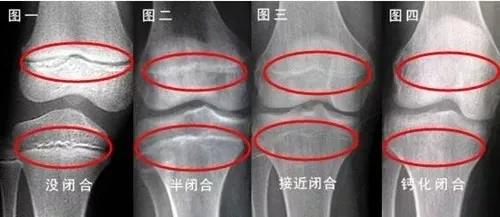 9岁乳房发育,10岁来“大姨妈”性早熟身高不到153cm!该怎么帮她