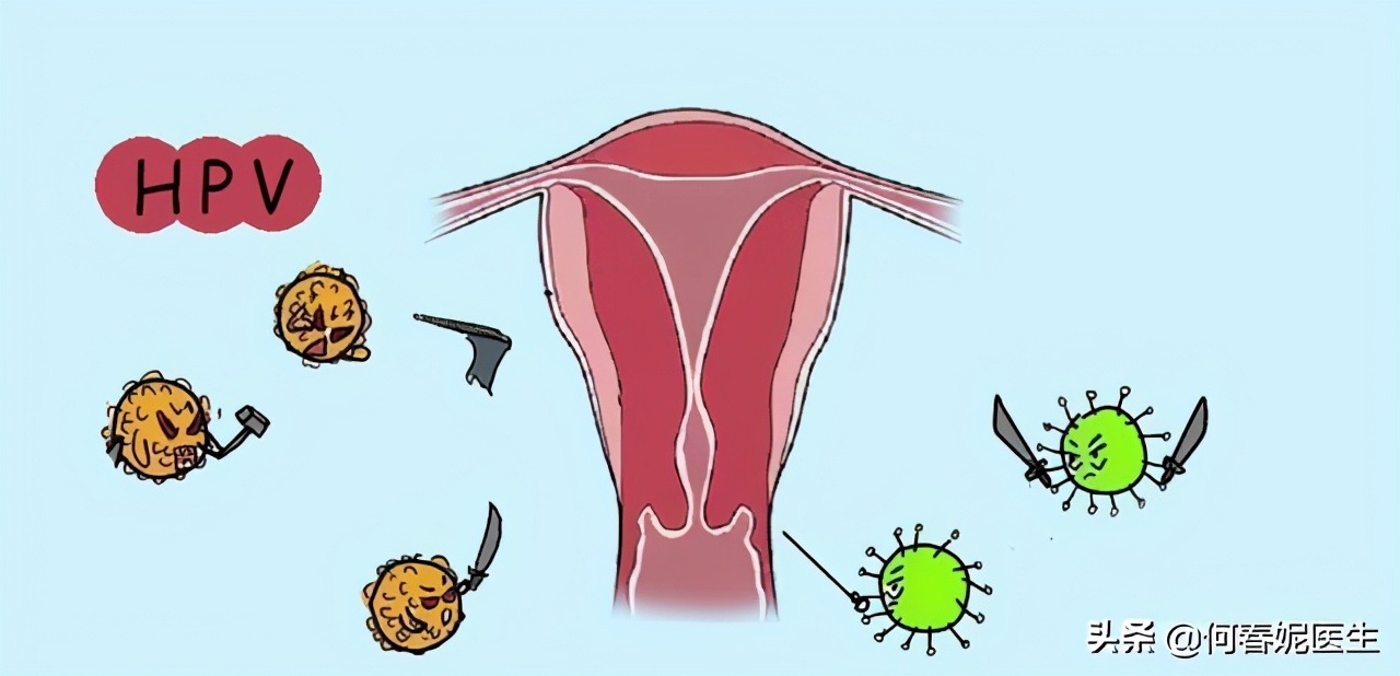 感染了HPV该如何处理？