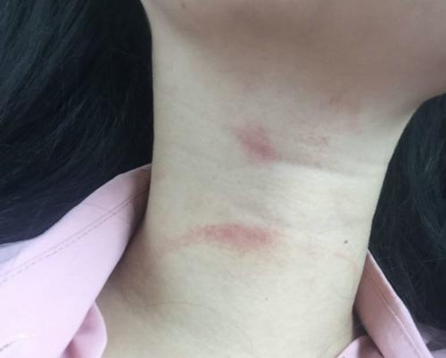 女儿身上有吻痕,女儿脖子上有黑色纹