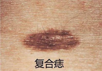 痣能点吗,我的痣凸起来会癌变吗