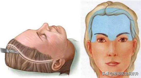 额部除皱术的目的是什么,什么是额部除皱术