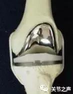 膝关节骨关节炎的阶梯型治疗方案,膝骨关节炎阶梯式治疗