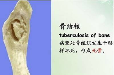 拒绝骨髓手术,中医治疗骨结核