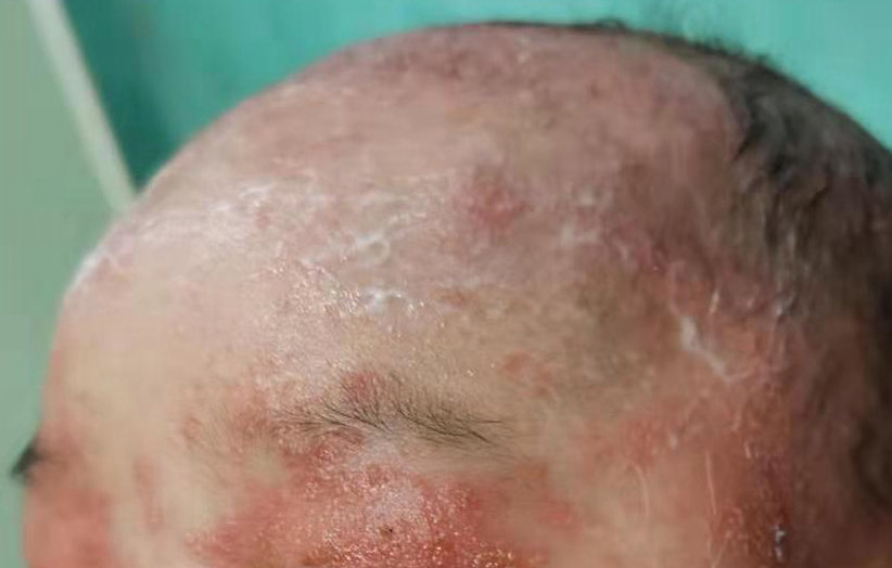 湿疹对颜值的影响,宝宝湿疹影响颜值吗