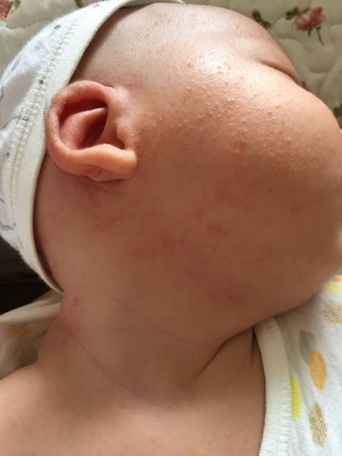 宝宝身上有小疙瘩怎么消除,宝宝身上小疙瘩图片