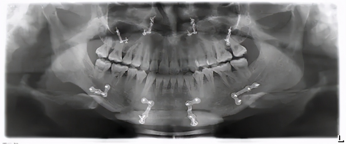歪脸严重怎么调整,歪脸怎么改善最有效