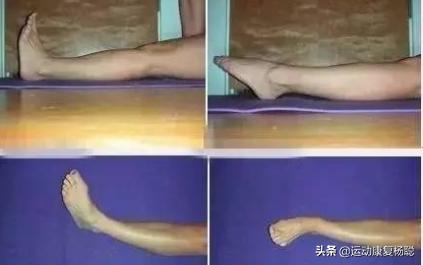 踝关节骨折术后4周康复训练视频,踝关节骨折后遗症有哪些