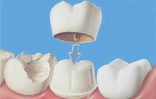 戴烤瓷牙有没有什么后遗症,全烤瓷牙有什么风险和后遗症