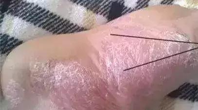 夏天不想穿凉鞋又怕得脚气怎么办,脚气夏天穿不了凉鞋怎么办