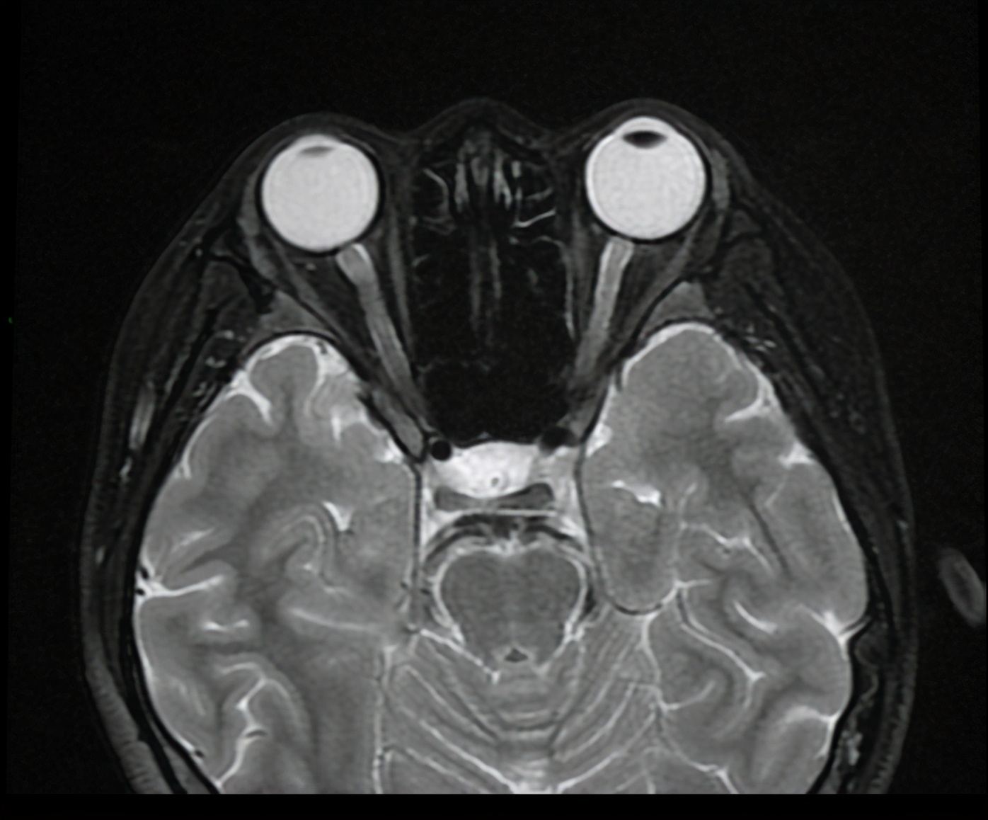 小孩淋巴结核肿大怎么办,儿童淋巴结结核如何治疗